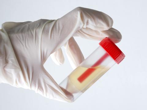 Urine container in gloved hand