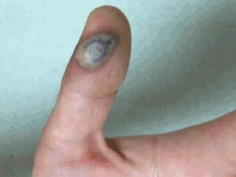 Vaccinia lesion