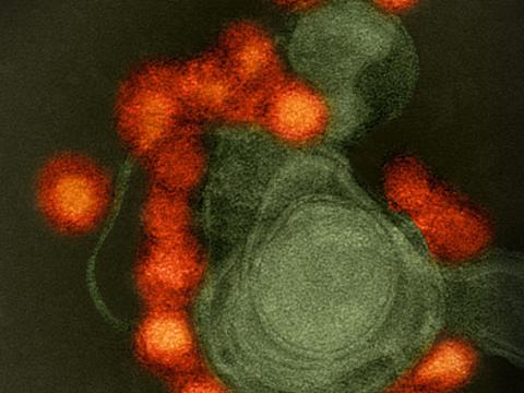 Zika virus from microcephaly case