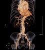 Aortic aneurysm on CT
