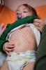 Baby with measles
