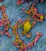 E coli bladder infection