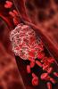 Blood clot illustration