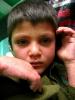 Young boy with measles