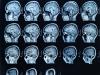 Brain scan