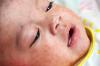 Measles baby