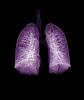 Chest CT purple lungs