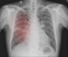 Chest x-ray