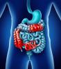 Illustration of Crohn's disease