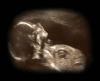 fetal ultrasound