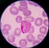 Malaria parasite in blood