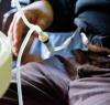 Man undergoing dialysis