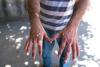 pox hands