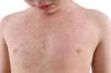 measles torso