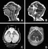 Microcephaly MRI