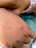 Monkeypox lesion on hand