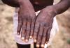 Monkeypox lesions on the back of the hands