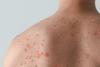 Monkeypox lesions on man's back