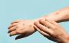 Monkeypox lesions on hands and arms