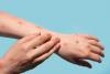 Monkeypox lesions on arm and hand