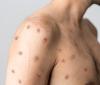 Monkeypox lesions on chest and arm