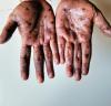 Monkeypox on person's hands