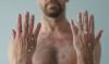 Monkeypox blisters on man's hands and chest