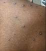 Monkeypox lesions on back and shoulder