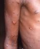 Monkeypox lesions on arm and torso
