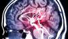 MRI of brain blood vessels
