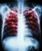 Pulmonary tuberculosis x-ray