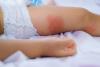 Rash on baby's leg