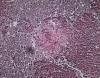 TB-infected lung tissue