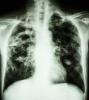 TB chest x-ray