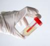 Urine container in gloved hand