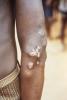 Yaws lesions on elbow