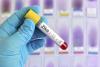 Zika sample